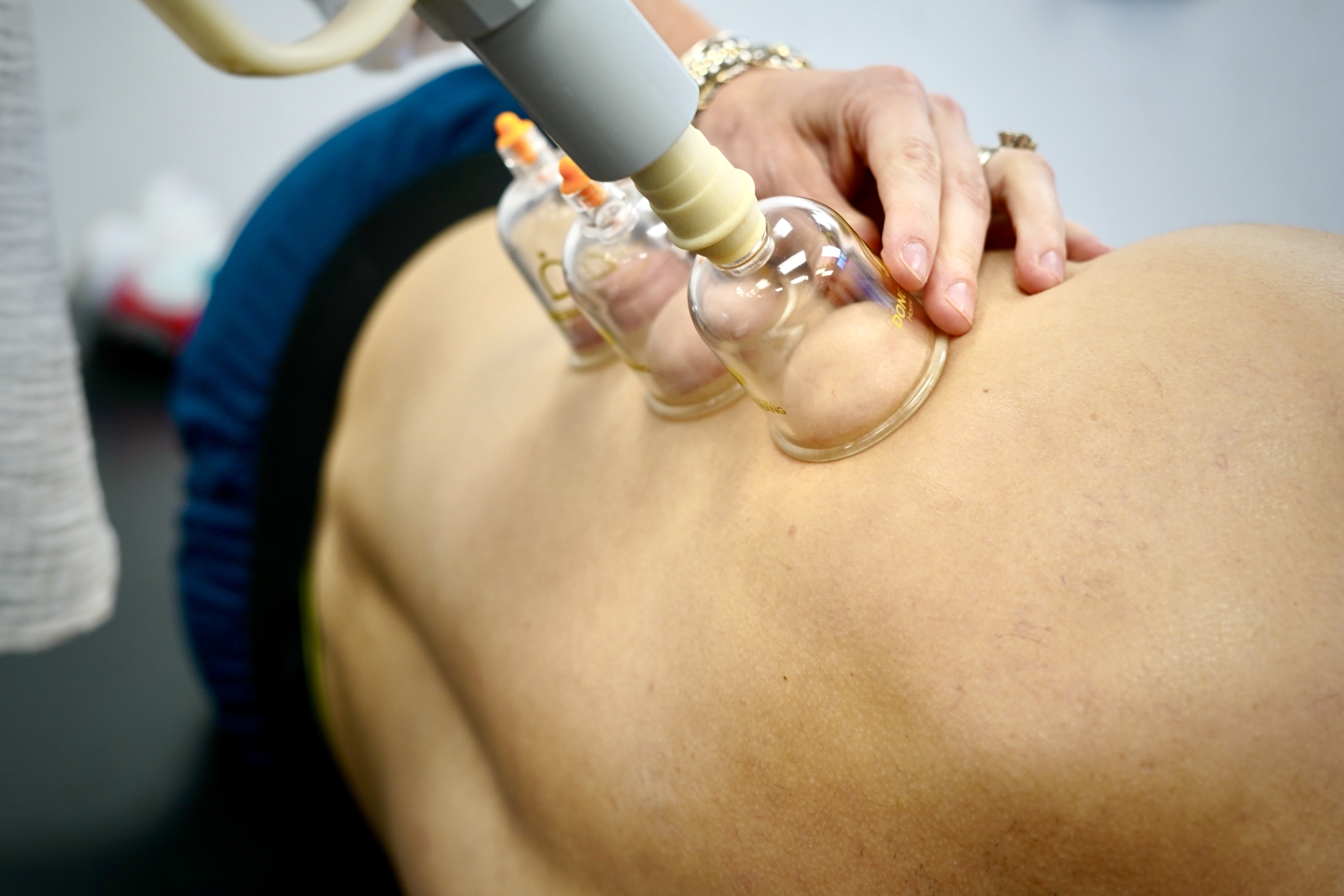 Cupping to the Right Upper Extremity to Improve Motion and Decrease Pain